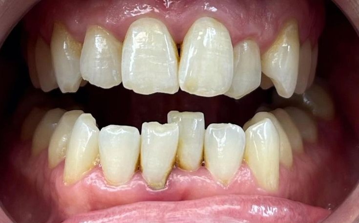 I pride myself in making the most natural straight teeth possible…that look fucking good! #instagood #transformation #makeover